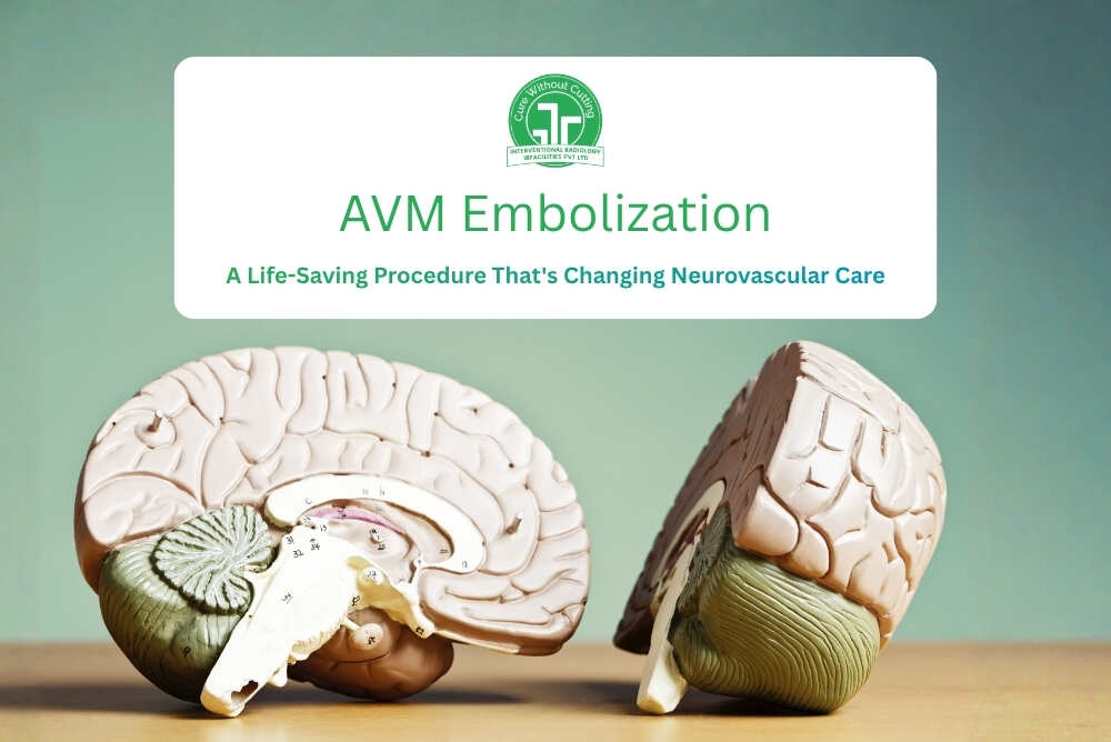 AVM Embolization: A Life-Saving Procedure That's Changing Neurovascular Care