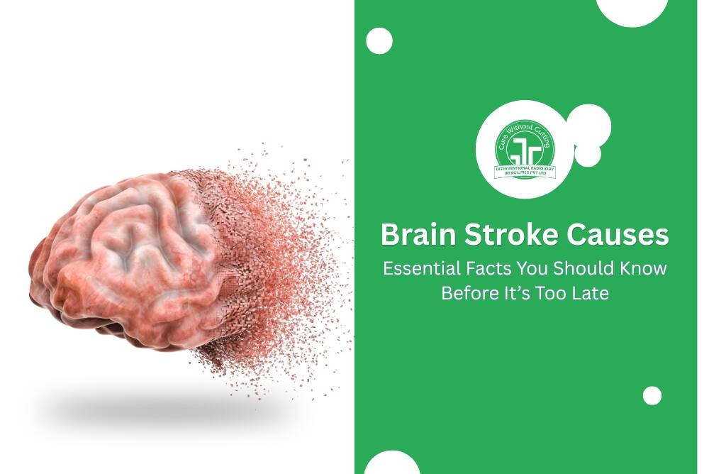 Brain Stroke Causes Essential Facts You Should Know Before Its Too Late