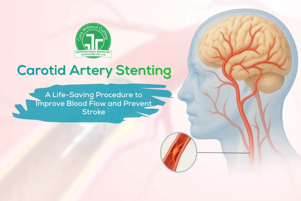 Carotid Artery Stenting A Life-Saving Procedure to Improve Blood Flow and Prevent Stroke