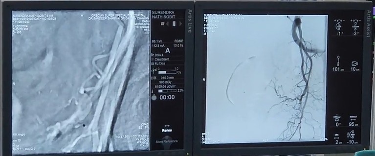 Introduction of Prostate Artery Embolization