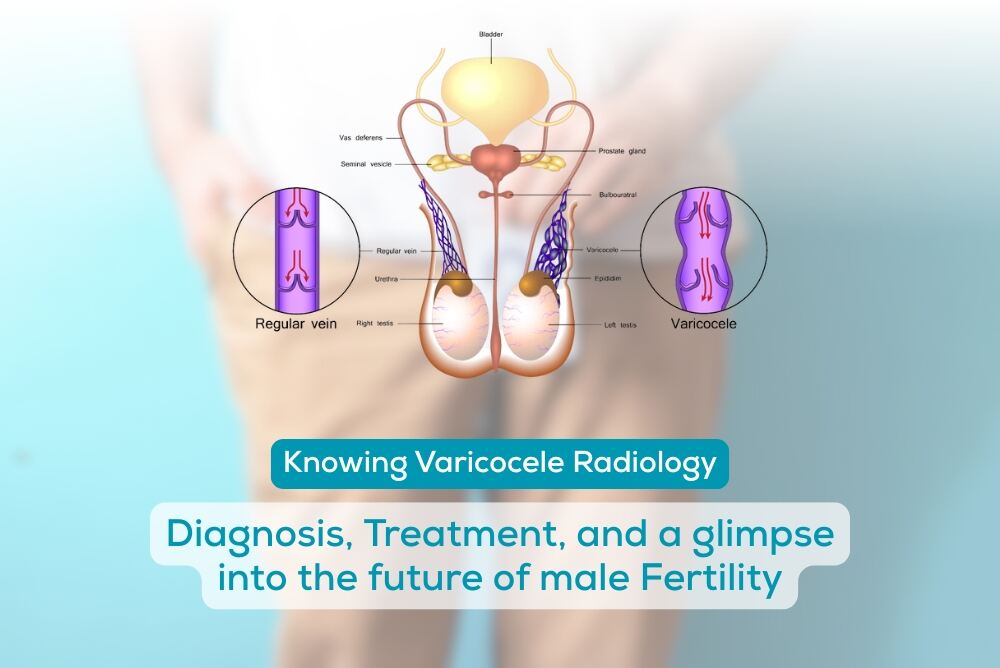 Knowing Varicocele Radiology: Diagnosis, Treatment, and a glimpse into the future of male Fertility