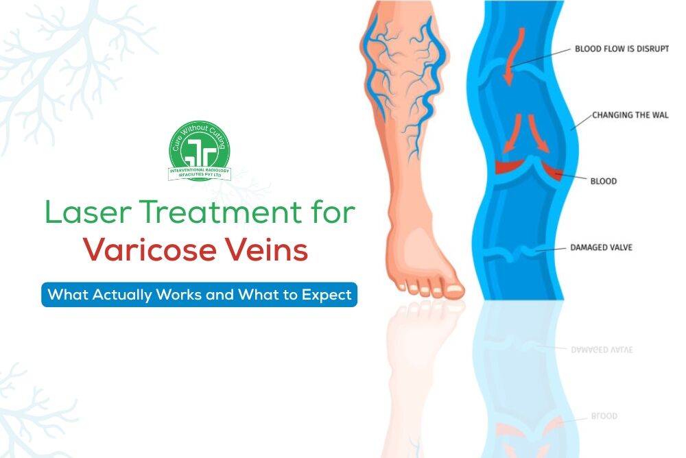Varicose Veins