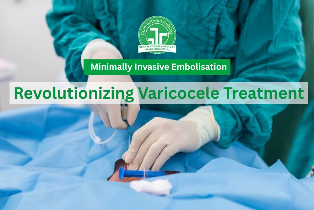 Minimally Invasive Embolisation Revolutionizing Varicocele Treatment