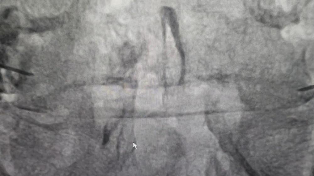 Post-treatment DSA image showing improved S1–S2 spinal nerve condition after back pain procedure at IRfacilities India