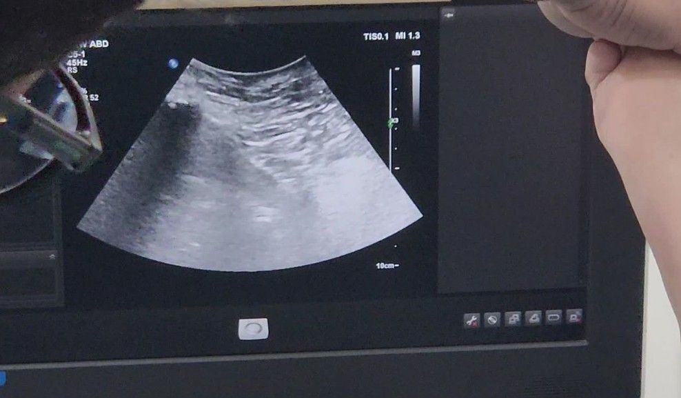 Prostate Transperineal Percutaneous Ablation Using Microwave