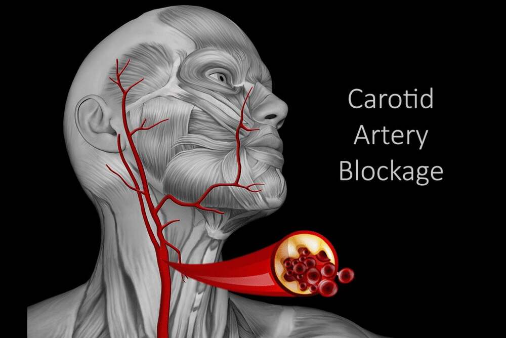 Symptoms of Carotid Artery Stenosis