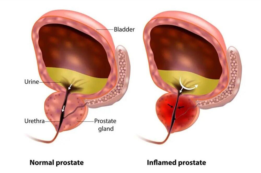 Symptoms of Enlarged Prostate BPH