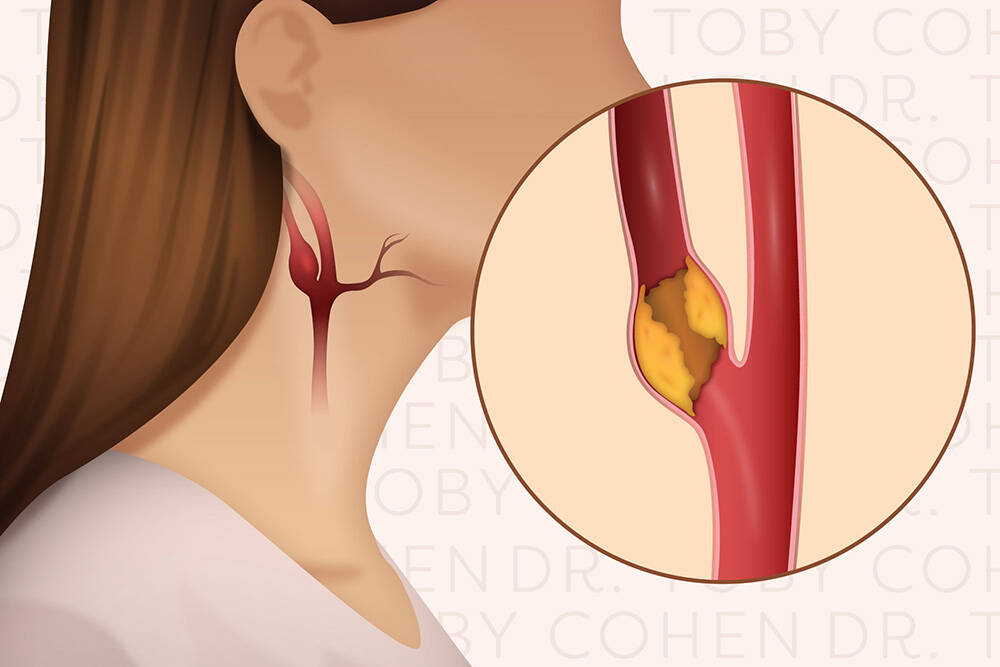 Treatment Options for Carotid Artery Stenosis