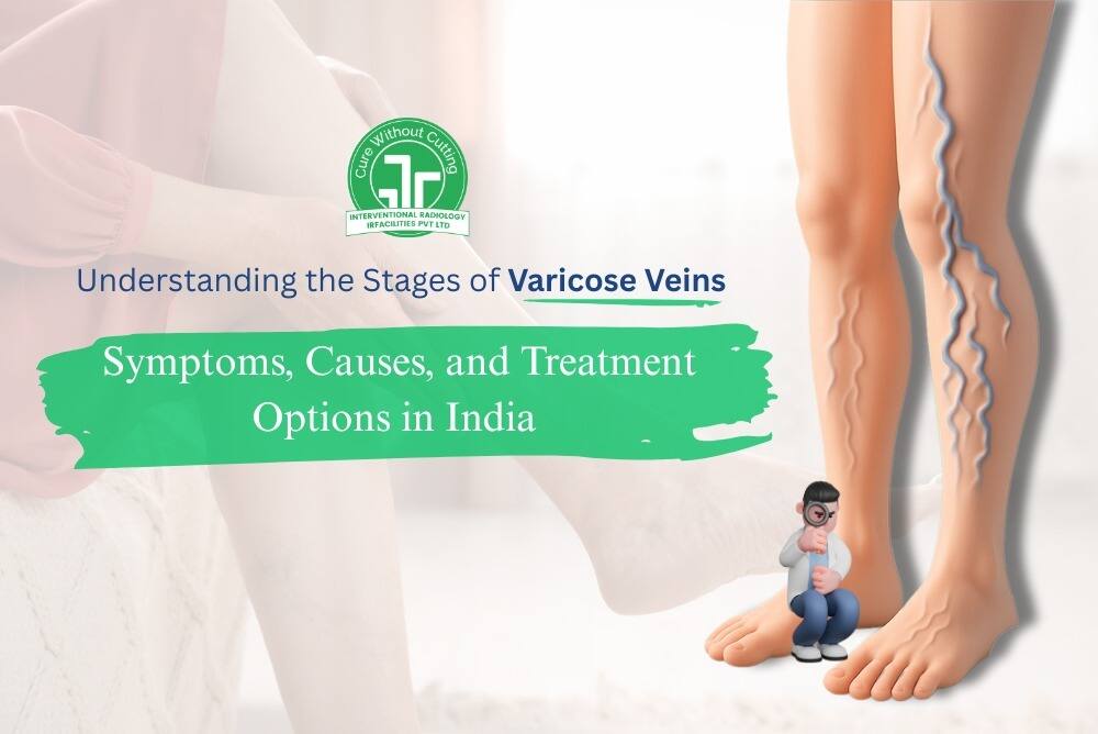 Understanding the Stages of Varicose Veins Symptoms Causes and Treatment Options in India