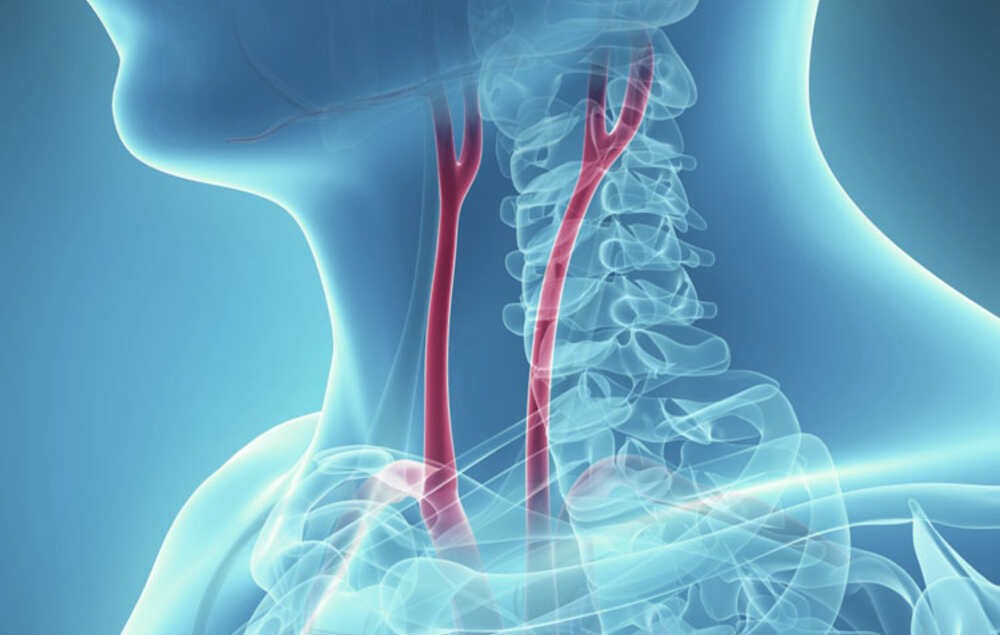 Understanding Carotid Arteries and Stroke