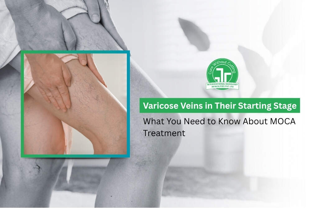 Varicose Veins in Their Starting Stage What You Need to Know About MOCA Treatment