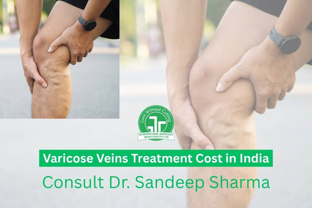 Varicose veins treatment cost in India – Dr. Sandeep Sharma at IRFacilities