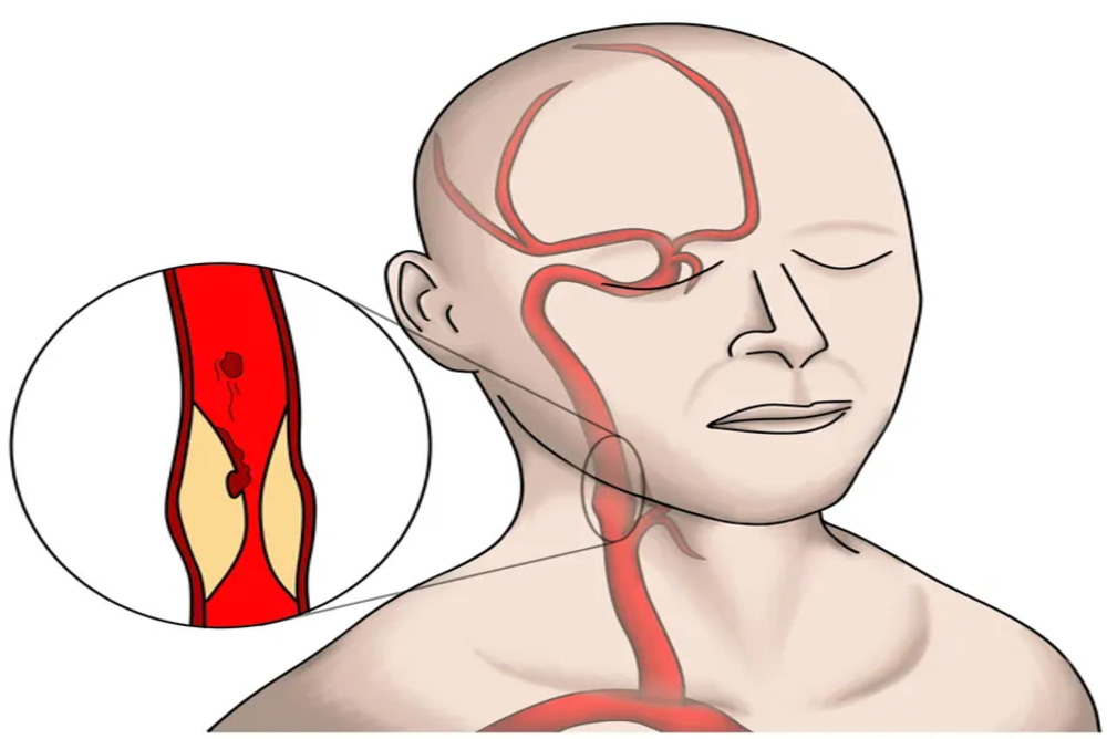What Is Carotid Artery Stenosis
