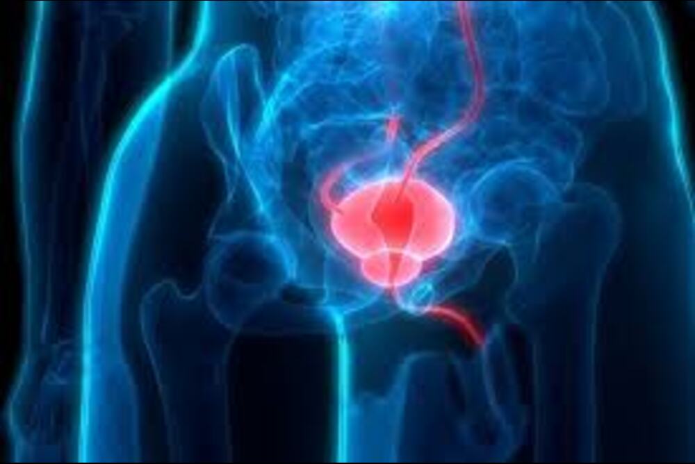 What Is Prostate Artery Embolization
