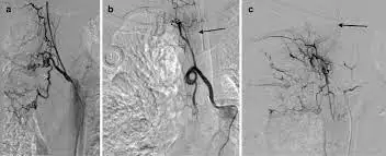 Bronchial Artery Embolization