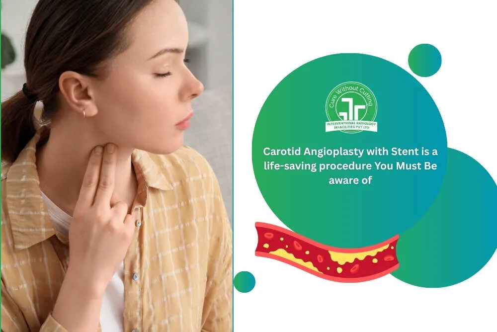 Carotid Angioplasty with Stent is a life saving procedure You Must Be aware of