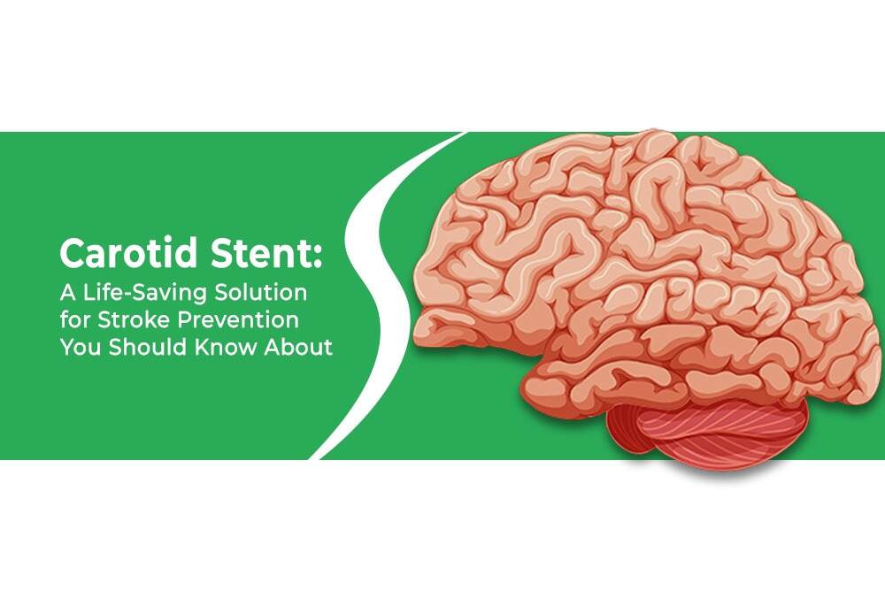 Carotid Stent A Life Saving Solution for Stroke Prevention You Should Know About