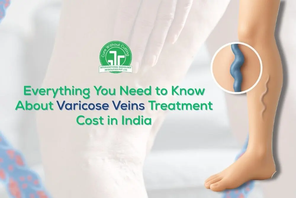 Varicose Veins