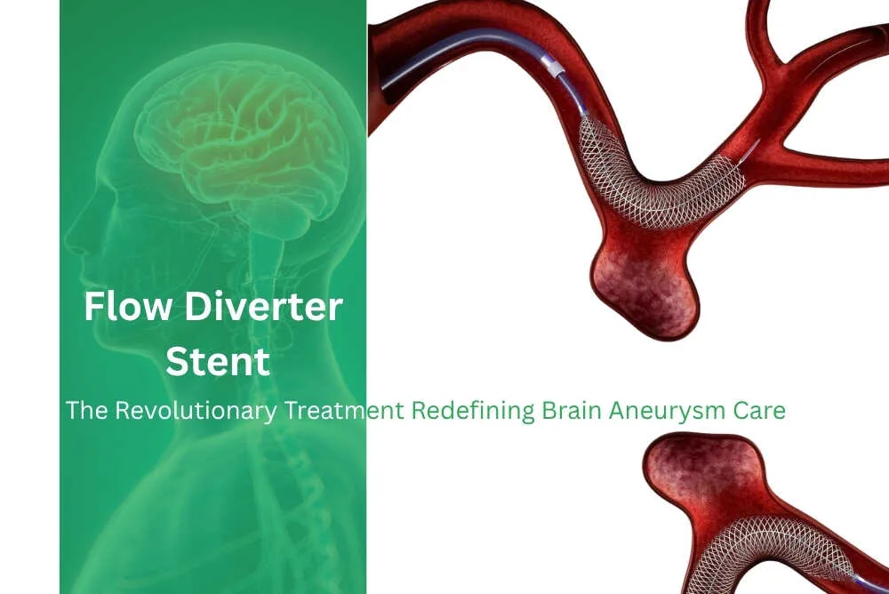 Flow Diverter Stent The Revolutionary Treatment Redefining Brain Aneurysm Care