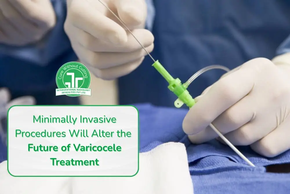 Varicocele Treatment