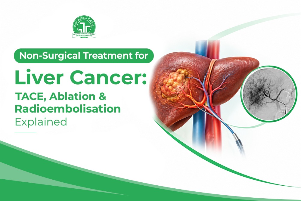 Non Surgical Treatment for Liver Cancer TACE Ablation Radioembolisation Explained