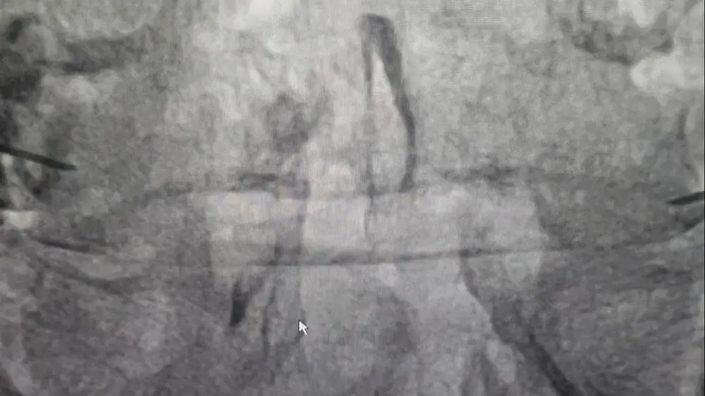 Post-treatment_DSA_image_showing_improved_S1%E2%80%93S2_spinal_nerve_condition_after_back_pain_procedure_at_IRfacilities_India