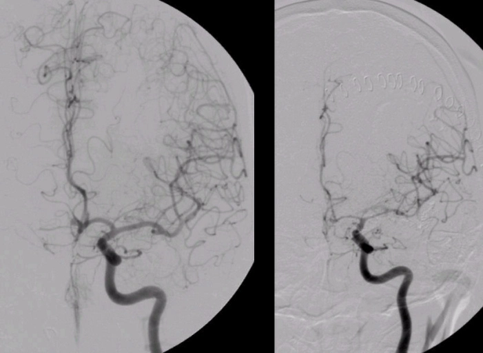 SAH Vasospasm
