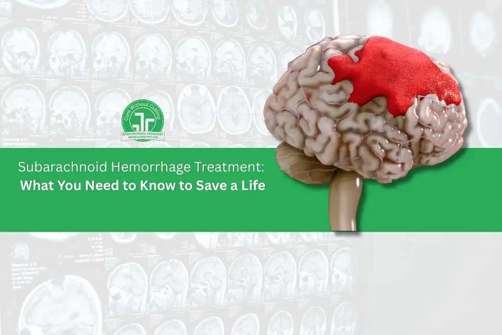 Subarachnoid Hemorrhage Treatment What You Need to Know to Save a Life