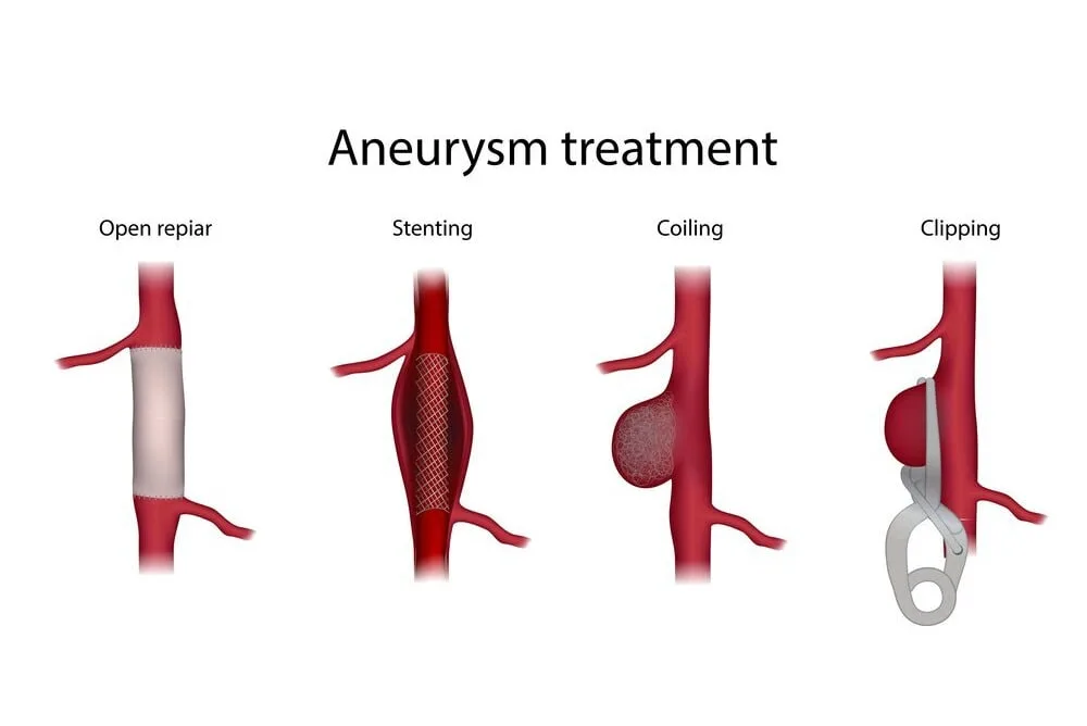Aneurysm Coiling