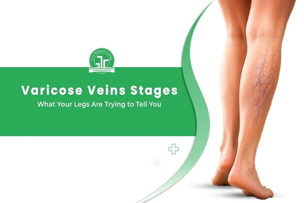 Varicose Veins Stages What Your Legs Are Trying to Tell You