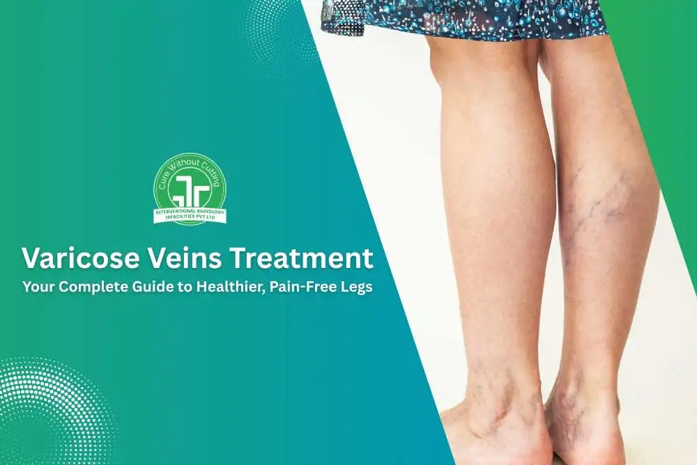 Varicose Veins Treatment Your Complete Guide to Healthier Pain Free Legs