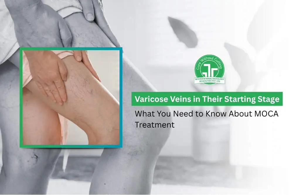Varicose Veins in Their Starting Stage What You Need to Know About MOCA Treatment
