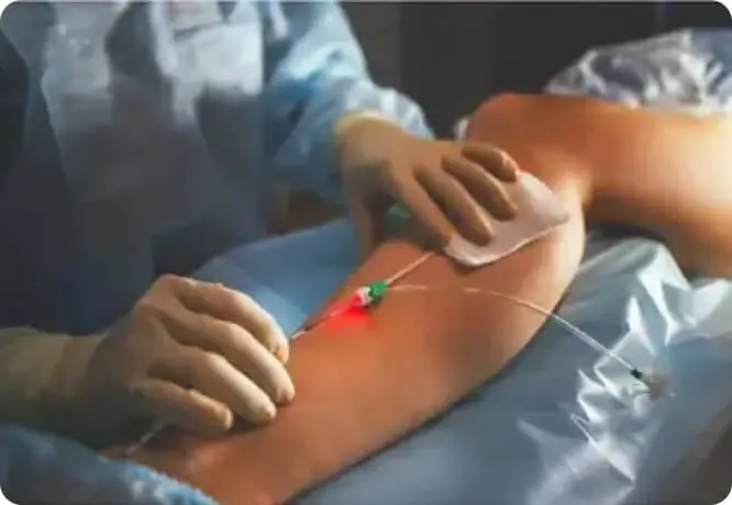 varicose_vein